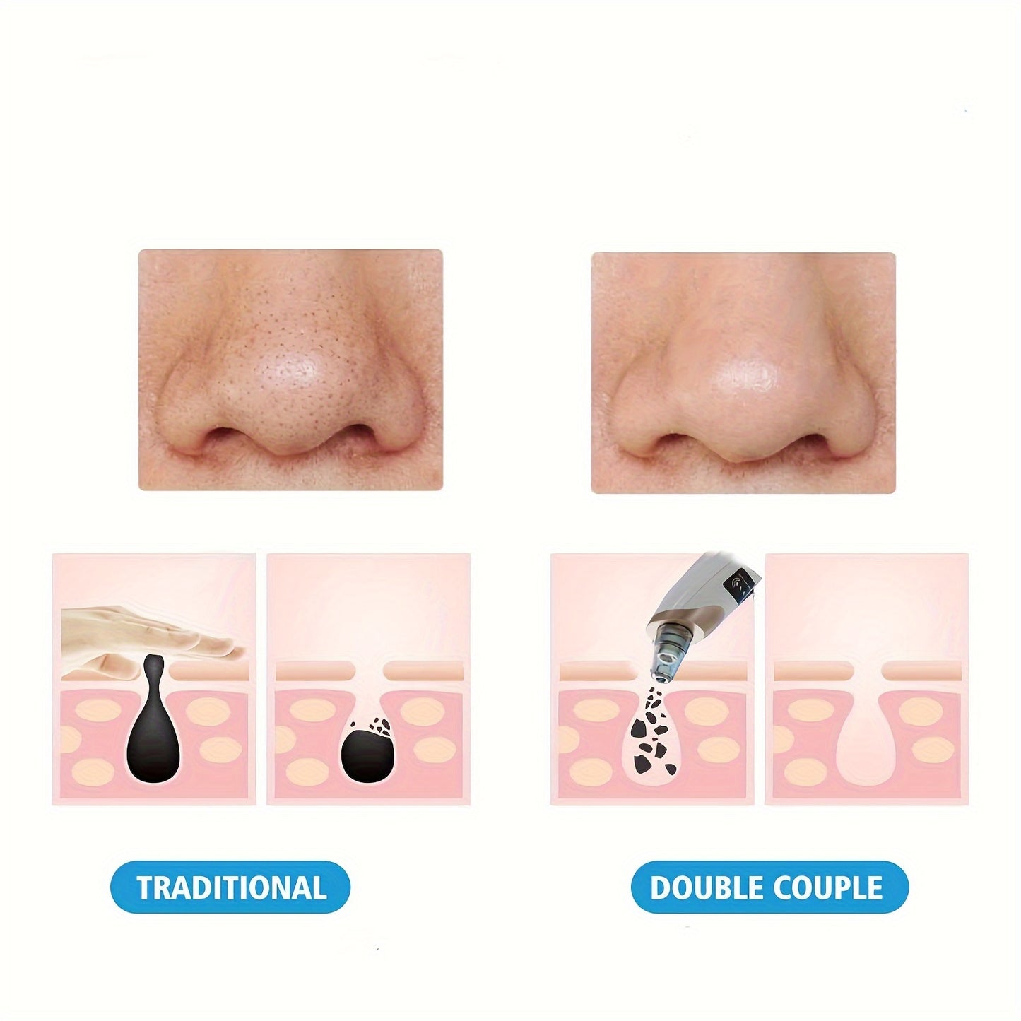 Blackhead Remover Pore Vacuum - 5 Suction - USB Rechargeable Facial Pore Cleaner Kit For Adult Acne Extractor Tool - Multifunctional Cleaning Instrument - Holiday Gift